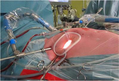 State-of-the-Art Review: Technical and Imaging Considerations in Novel Transapical and Port-Access Mitral Valve Chordal Repair for Degenerative Mitral Regurgitation